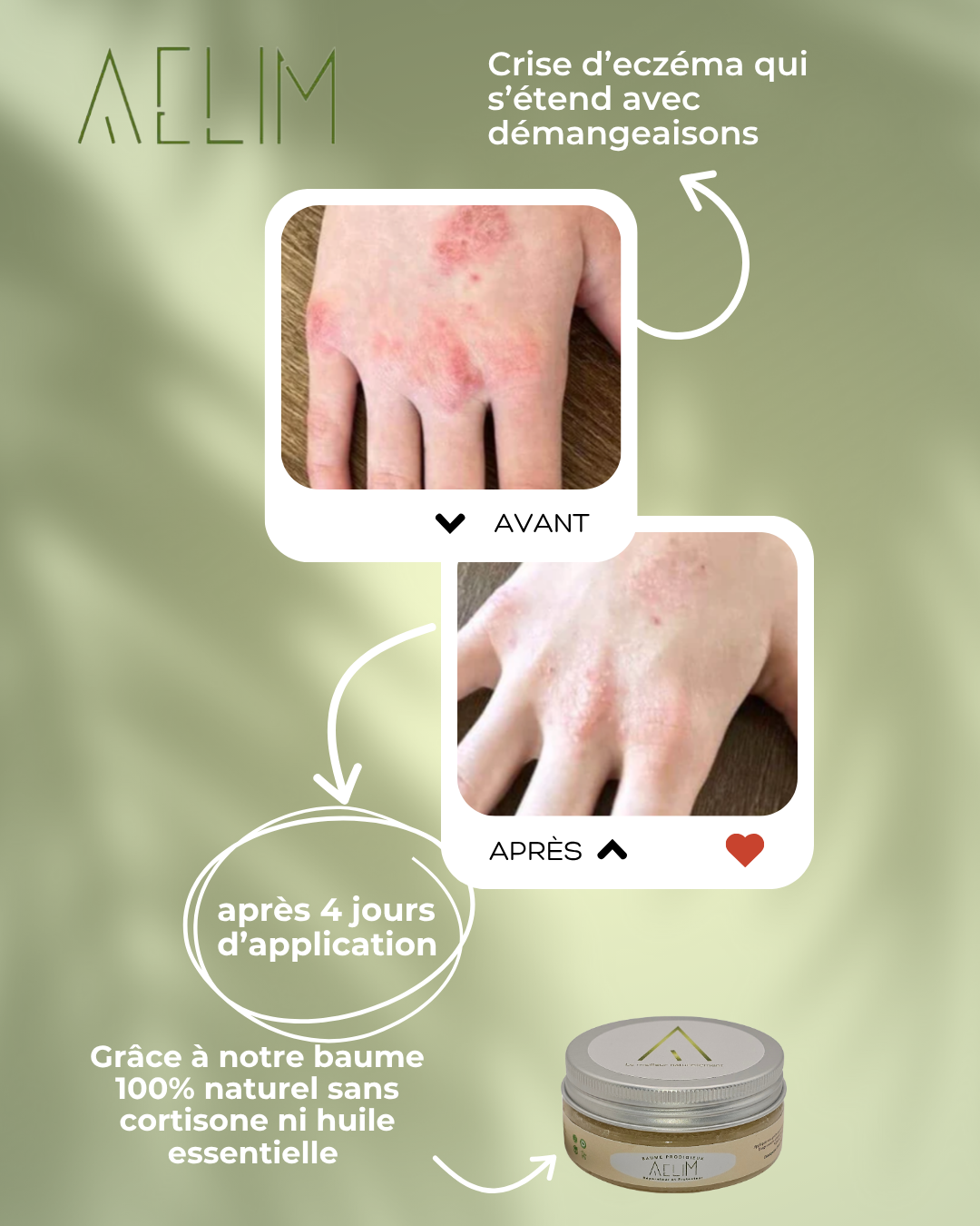 avant apres traitement eczema sur la main